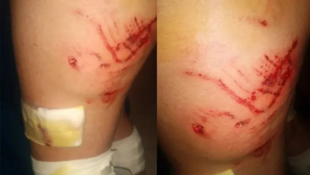 Pánico: una chica de 14 años fue atacada por los perros de su vecino cuando regresaba de la escuela 